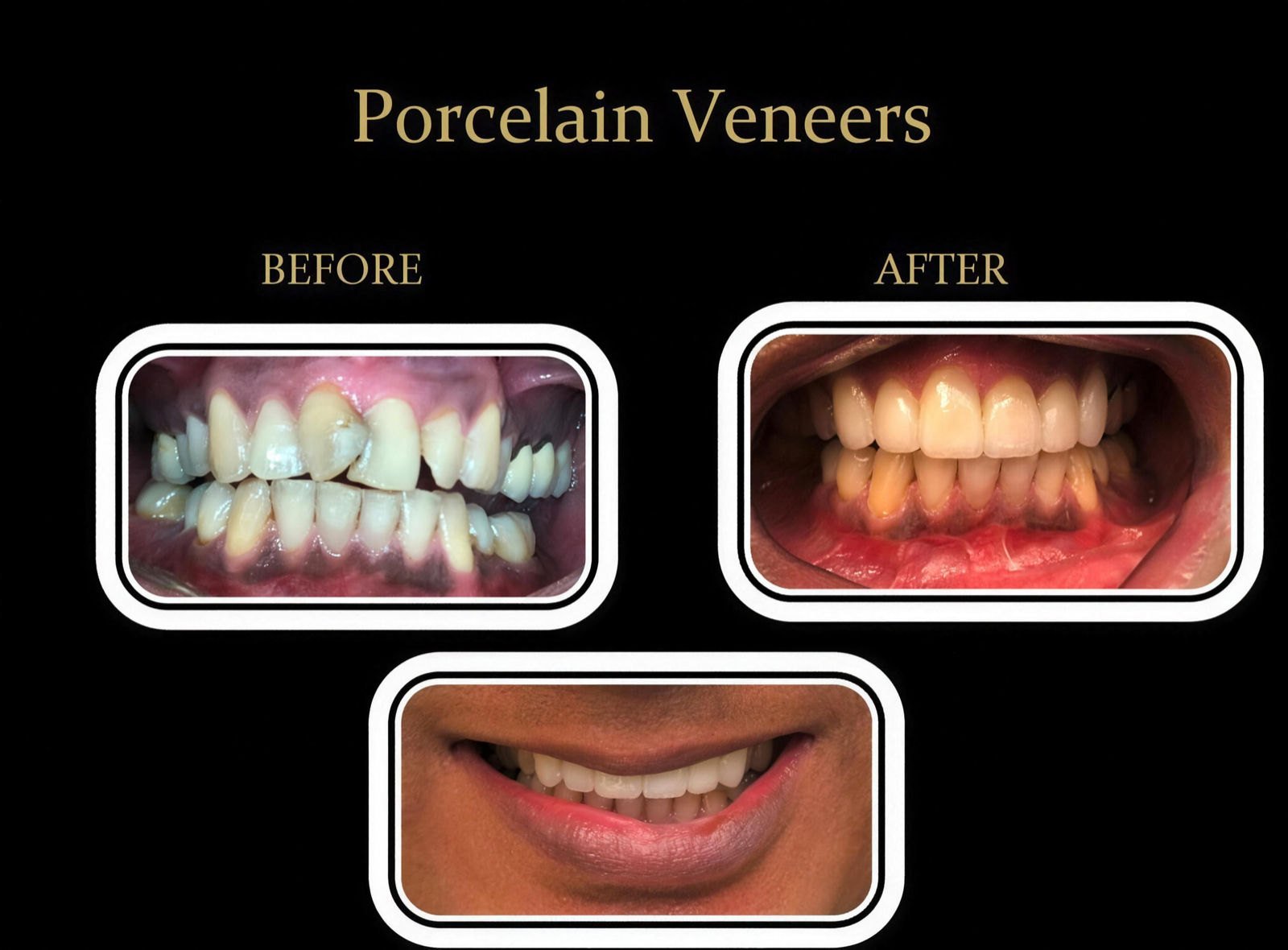 Real patient smile transformation — porcelain veneers by Dr. Prajesh Desai, Dublin CA