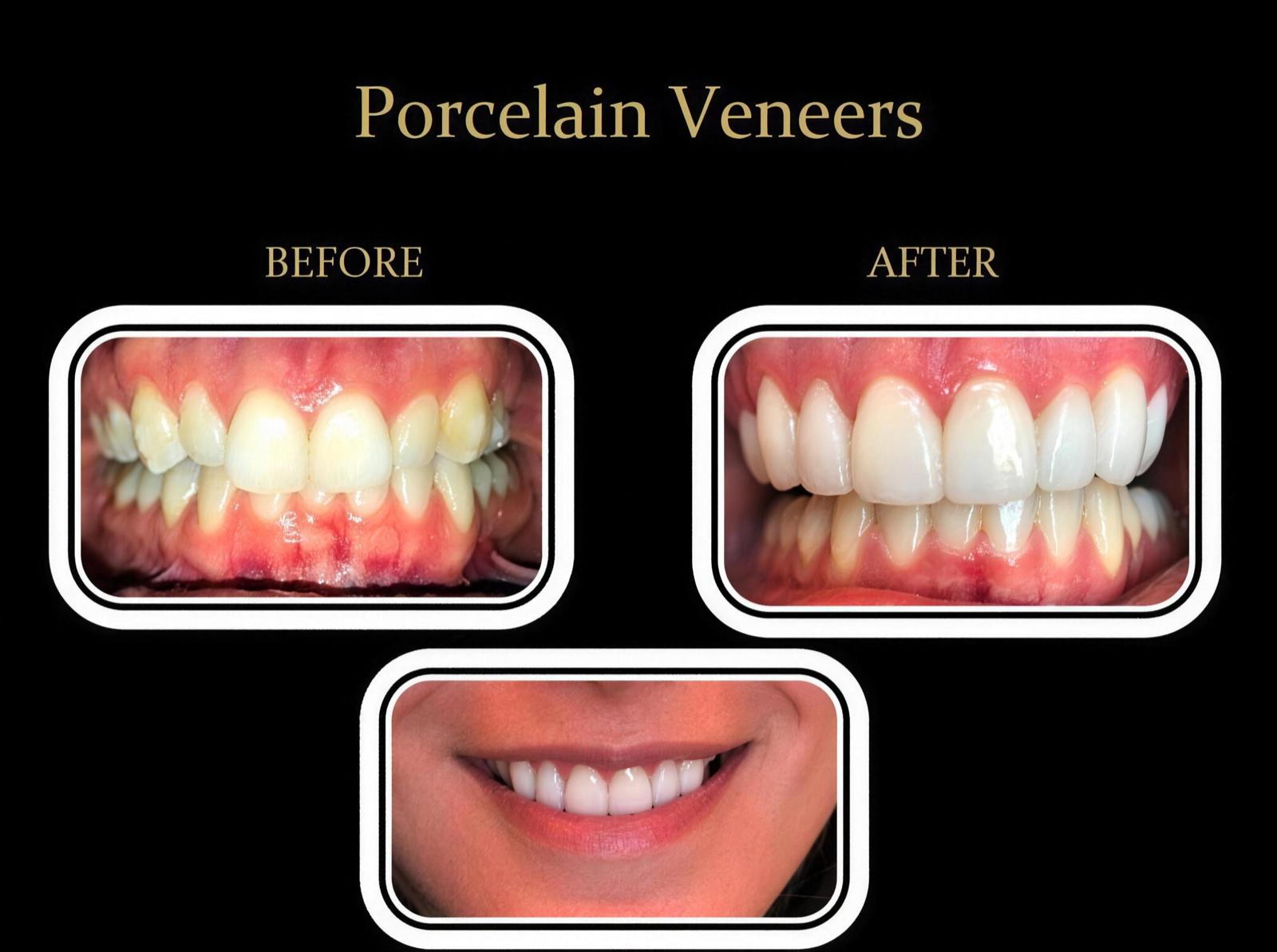 Before and after cosmetic dentistry result — Dublin Ranch Dental, Tri-Valley